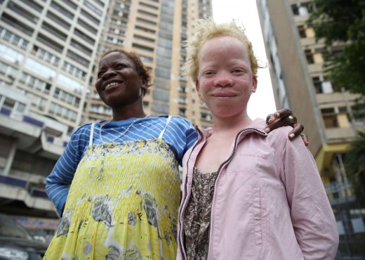 jeune fille albinos Kinshasa
